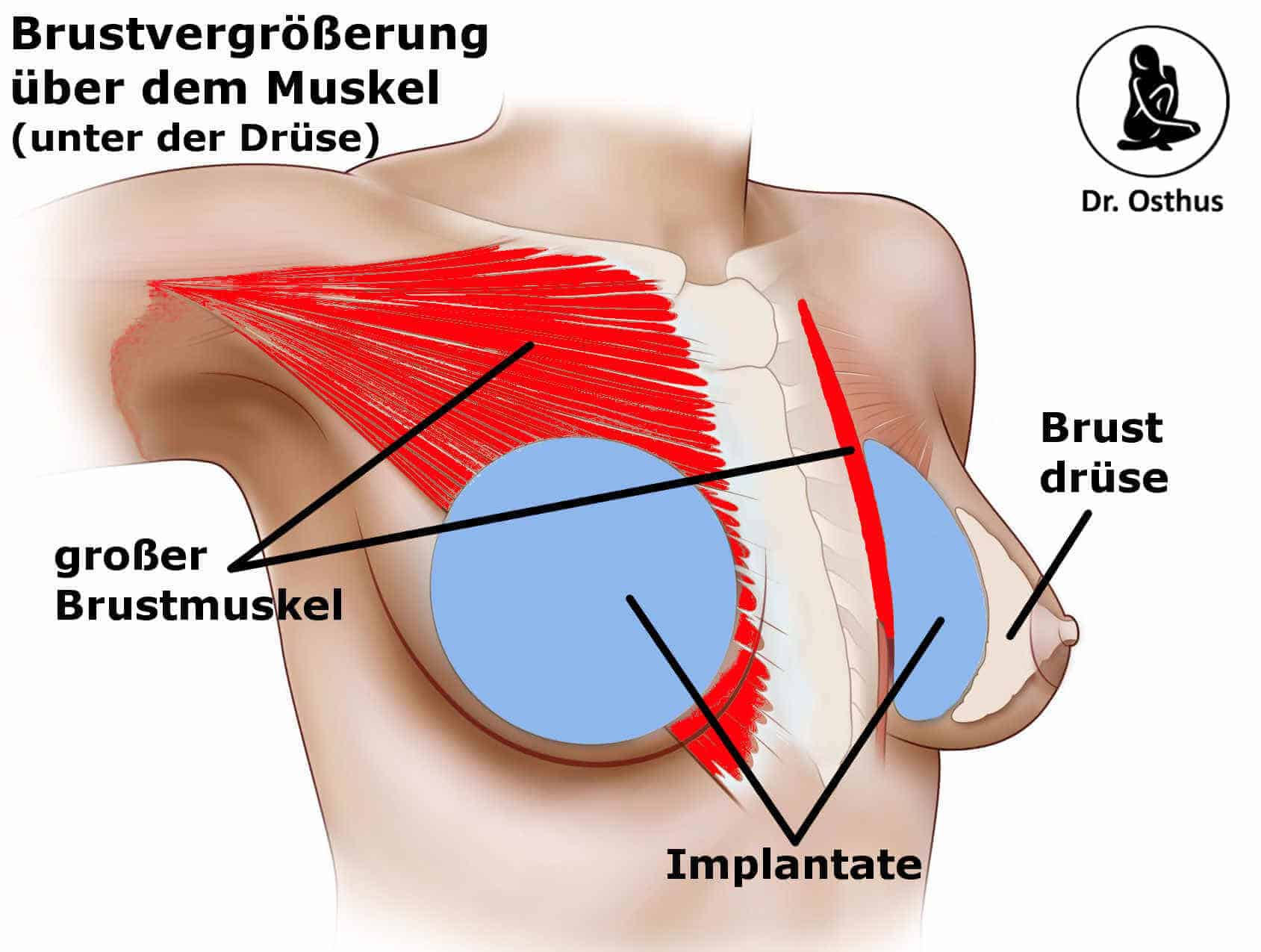 Brustvergrößerung über dem Muskel – TRAUMKLINIK bei Stuttgart