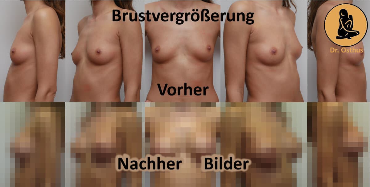 vorher-nachher-Bilder einer Brustvergrößerung
